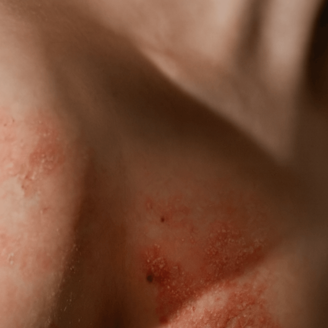 Peau rouge et irritée liée à une poussée d’eczéma atopique. Affection inflammatoire chronique de la peau, fréquente chez l’enfant et l’adulte, causant sécheresse, démangeaisons et inconfort.